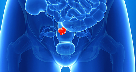 Uterine fibroid embolization (UFE) is a non-surgical technique that shrinks fibroids without removing them. The procedure is performed by an interventional radiologist, an M.D. with basic certification in radiology and special education and certification in interventional radiology. 